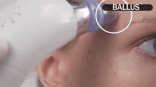Pore Cleaning Vacuum Device – Blackhead Remover with 5 Suction Levels